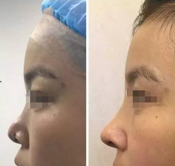 鼻子整形手术视频,从术前准备到术后恢复